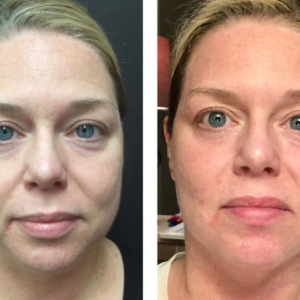 1 - Before & After and How Long They Las