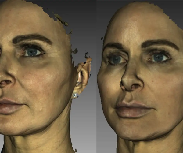 1 - Rhinoplasty, ChinJawline, Sof