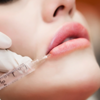 1 - Swelling Timeline, 2-Week Review, Avoiding2-Week Review, Avoiding MigrationOverfil