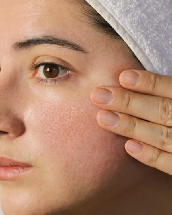 13. Enlarged Pores Treatment Calgary 13. Enlarged Pores Treatment Calgary