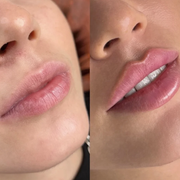 2 - Natural Shapes vs. Russian Lipvs. Russian Li