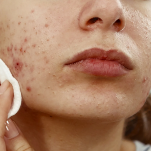 2 - Persistent or recurrent breakouts despite OTC care