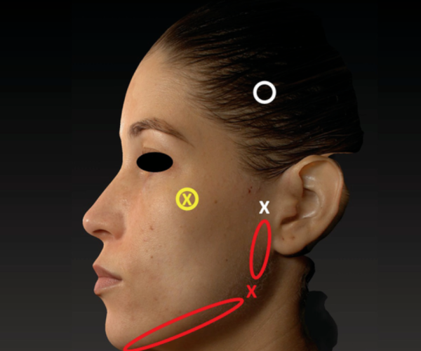 2 - Rhinoplasty, ChinJawline, Sof