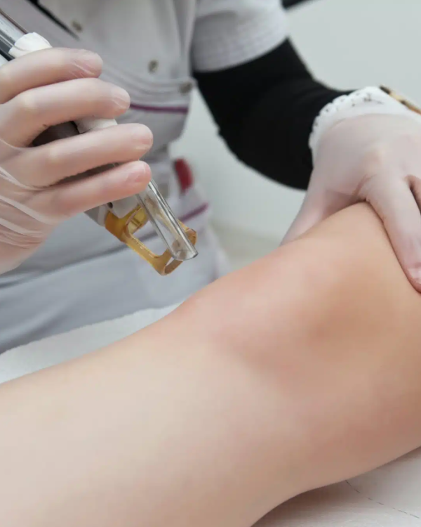 25 - Laser Vein Treatmen