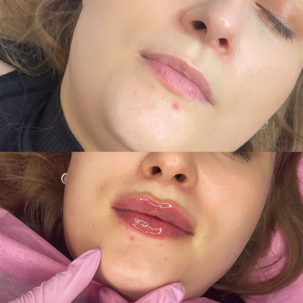 3 - Natural Shapes vs. Russian Lipvs. Russian L