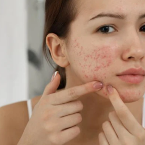 3 - Photosensitivity with retinoids and tetracycline