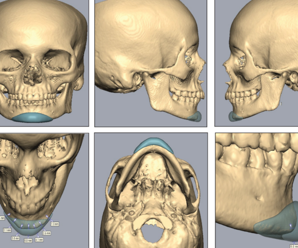 3 - Rhinoplasty, ChinJawline, Sof