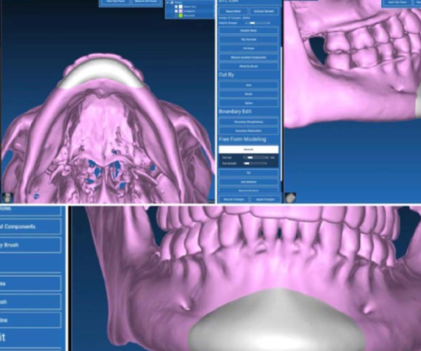 4 - Rhinoplasty, ChinJawline, Sof