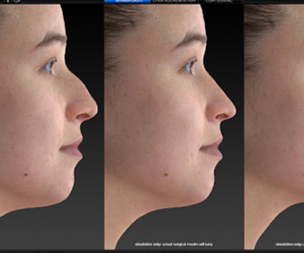 5 - Rhinoplasty, ChinJawline, Sof
