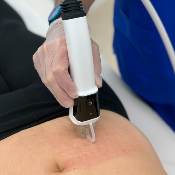 5.) Calgary Stretch Mark Removal