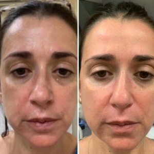 6 - Before & After and How Long They Last