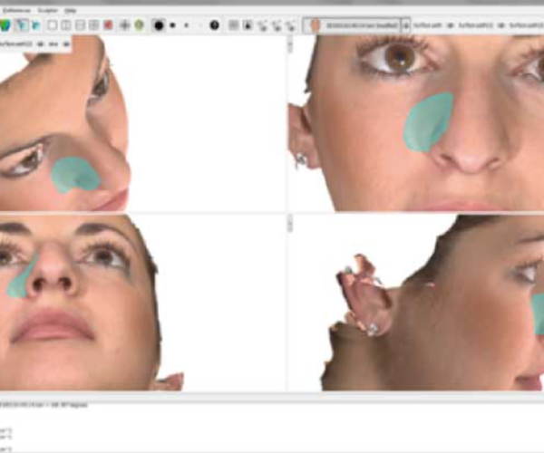 6 - Rhinoplasty, ChinJawline, Sof