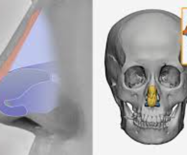 8 - Rhinoplasty, ChinJawline, Sof