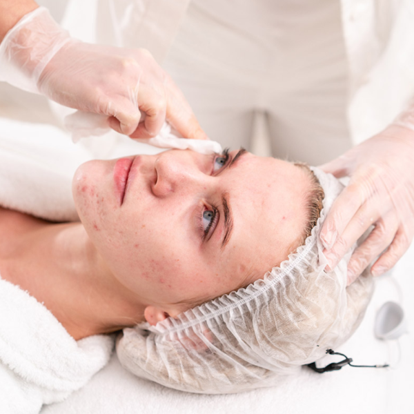 Acne Facial