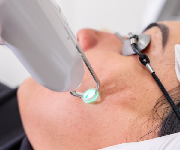 Acne Treatment Options in Calgary (Topicals, Oral Meds, Lasers, Peels Acne Treatment Options in Calgary (Topicals, Oral Meds, Lasers, Peels