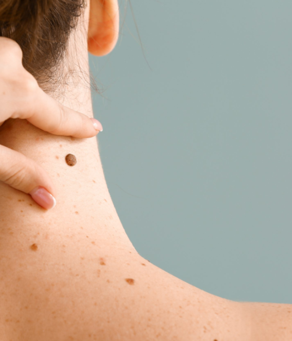 Actinic Keratoses—When to See a Dermatologis Actinic Keratoses—When to See a Dermatologis
