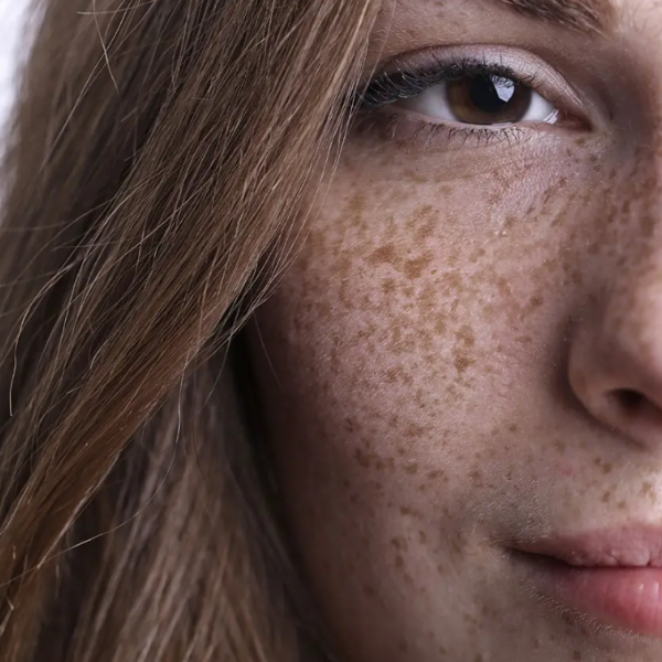 Brown Spots (Solar Lentigines) & Hyperpigmentatio Brown Spots (Solar Lentigines) & Hyperpigmentatio