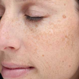Brown spots (solar lentigines) and uneven ton