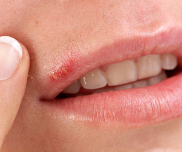 Cold Sores (HSV-1) and Valacyclovirand Valacyclovir Prophylaxis Cold Sores (HSV-1) and Valacyclovirand Valacyclovir Prophylaxis