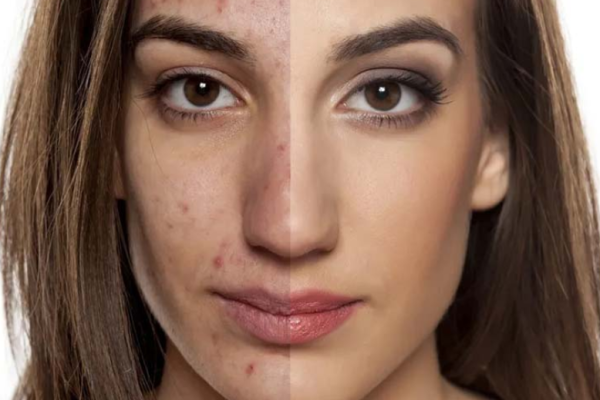 Contraindications & Isotretinoin Washou