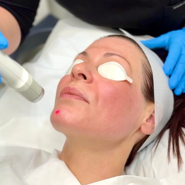 Dermal Heating Fibroblast, Collagen and Elasti
