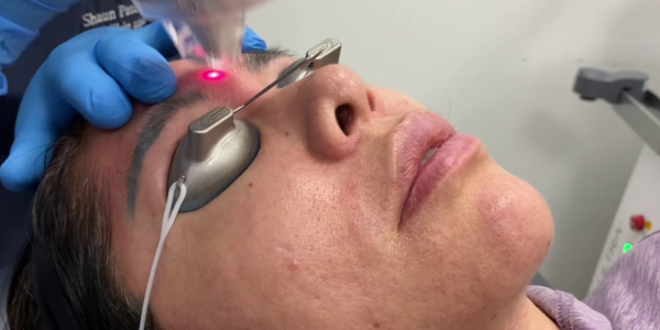 Fractional Resurfacing (LaseMD Ultra) for Phymato