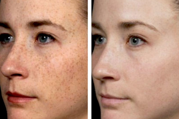 IPLBBL Photofacial for Brown Spots &for Brown Spots & Rednes IPLBBL Photofacial for Brown Spots &for Brown Spots & Rednes
