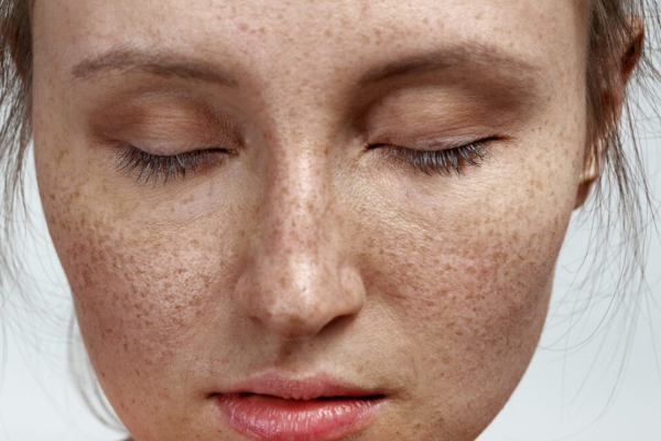 Pigment Depth (Epidermal vs Dermal) an