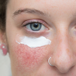 Rednesstelangiectasia and blotchines