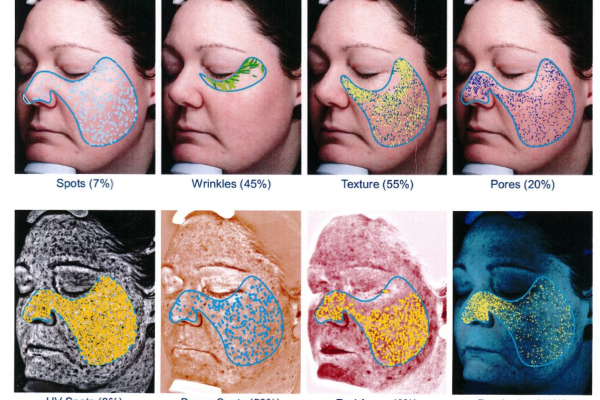 Skin Exam, Dermoscopy, VISIA & GlogauDermoscopy, VISIA & Glogau Scal Skin Exam, Dermoscopy, VISIA & GlogauDermoscopy, VISIA & Glogau Scal