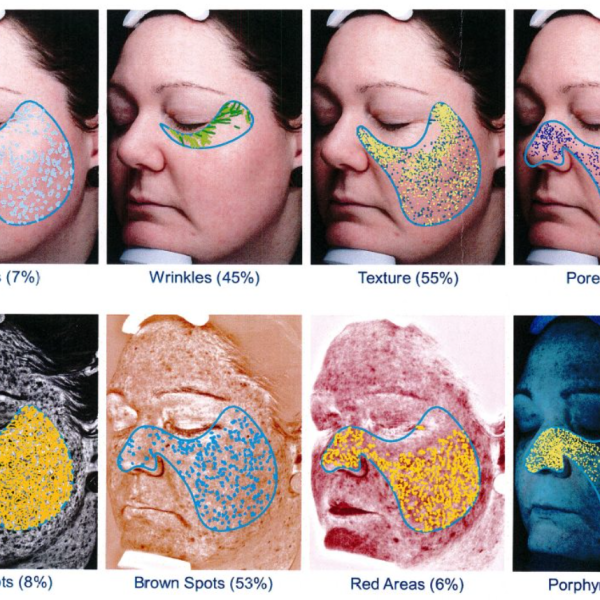 Skin Exam, Dermoscopy, VISIA & GlogauDermoscopy, VISIA & Glogau Scal Skin Exam, Dermoscopy, VISIA & GlogauDermoscopy, VISIA & Glogau Scal