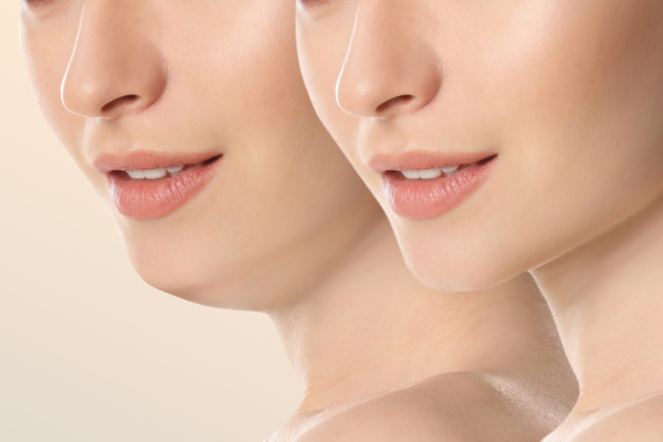 Skin Laxity vs Fat The Role of Collage Skin Laxity vs Fat The Role of Collage
