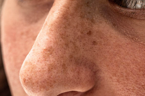 Sun spotsage spots (solar lentigines) Sun spotsage spots (solar lentigines)