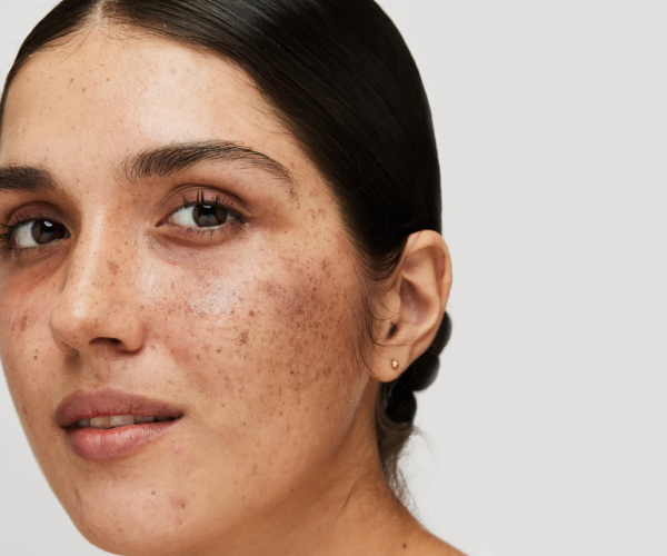 Targeted protocols for specific concerns (melasma, hyperpigmentation Targeted protocols for specific concerns (melasma, hyperpigmentation