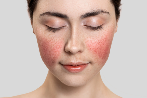 Temporary redness, swelling, tendernes