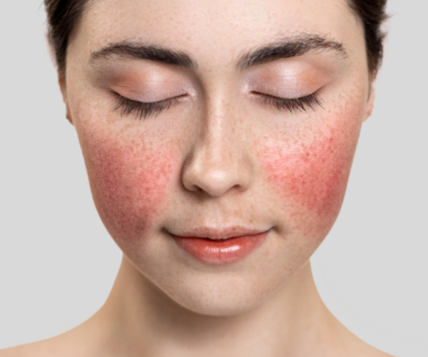 Temporary redness, swelling, tendernes Temporary redness, swelling, tendernes
