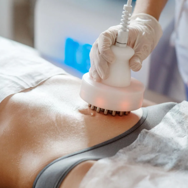 What Is Radiofrequency (RF) Skin Tightening