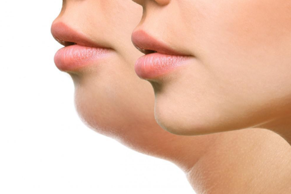 What Is a Double Chin (Submental Fullness) What Is a Double Chin (Submental Fullness)