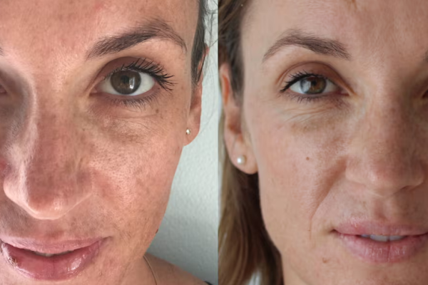 When to Expect Pigment Clearance & Texture Change When to Expect Pigment Clearance & Texture Change