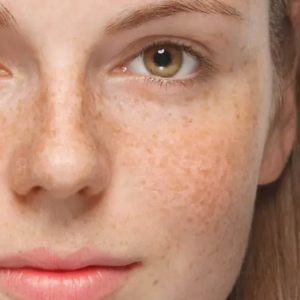 before - melasma