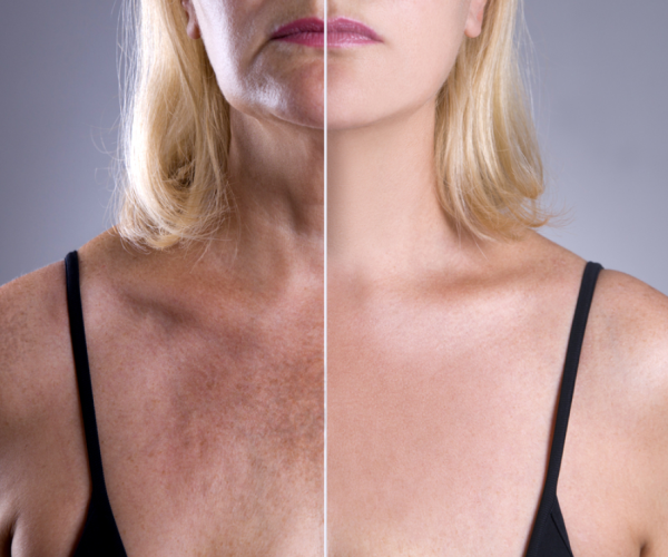 melasma vs sunspots melasma vs sunspots